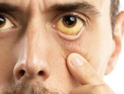 Rahasia Memutihkan Bola Mata Kuning Secara Alami: 5 Cara Ampuh